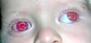 Albinismo oculare