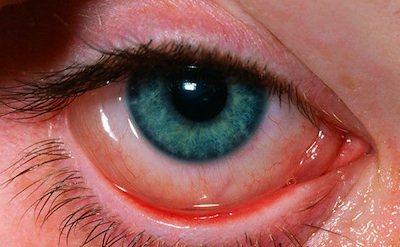 Occhi Rossi, Lacrimazione e Forte Prurito: ecco le allergie!