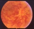 trombosi-venosa-retinica