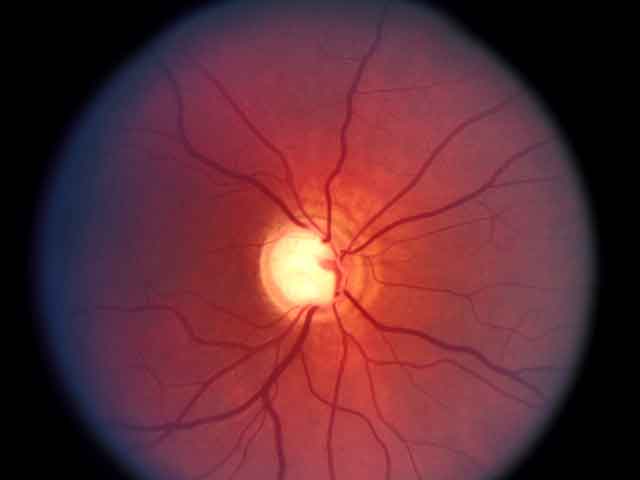 Glaucoma: Chi Sono i Soggetti a Rischio