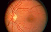 Malattia di Eales o Vasculopatia Obliterante della Retina Periferica