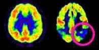 Rischio Alzheimer: Un Test per Identificarlo