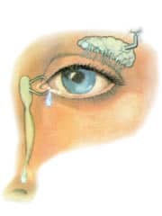 Ostruzione delle Vie Lacrimali