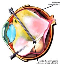 Dizionarietto di Oculoprotesica – Parte Seconda