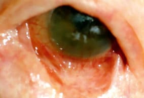Il Pemfigoide Oculare