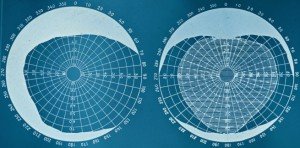 La Perimetria: Uno Strumento Diagnostico Nel Glaucoma
