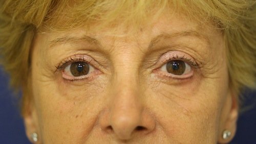 blefaroplastia