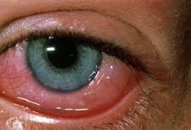 allergia-occhi